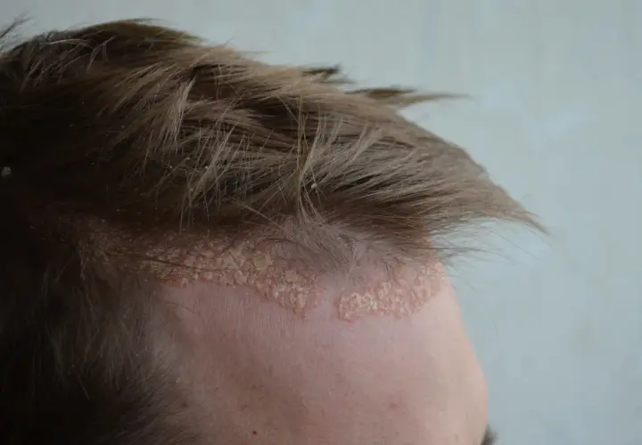 Dermatite seborroica e psoriasi sul cuoio capelluto: chiazze squamose e arrossate lungo l'attaccatura dei capelli.
