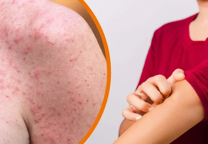 Rote, entzündete Haut mit vielen kleinen Pickelchen am Arm, die jucken. Hitzepickel am Arm sind unangenehm.