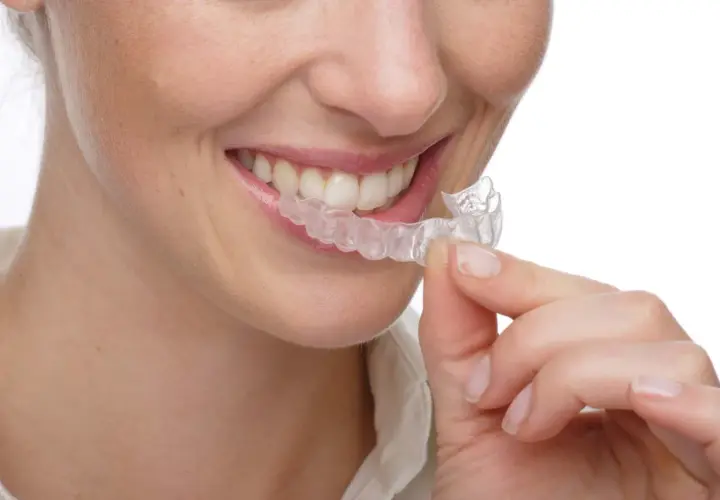 Sonrisa de mujer con férulas transparentes. A pesar de que los **invisalign duelen** un poco al principio, la sonrisa vale la pena.
