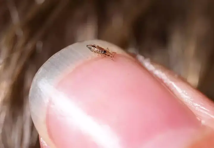 Un pidocchio, piccolo e scuro, si aggrappa a un'unghia. Forse il phon uccide i pidocchi, ma questo è ancora vivo.