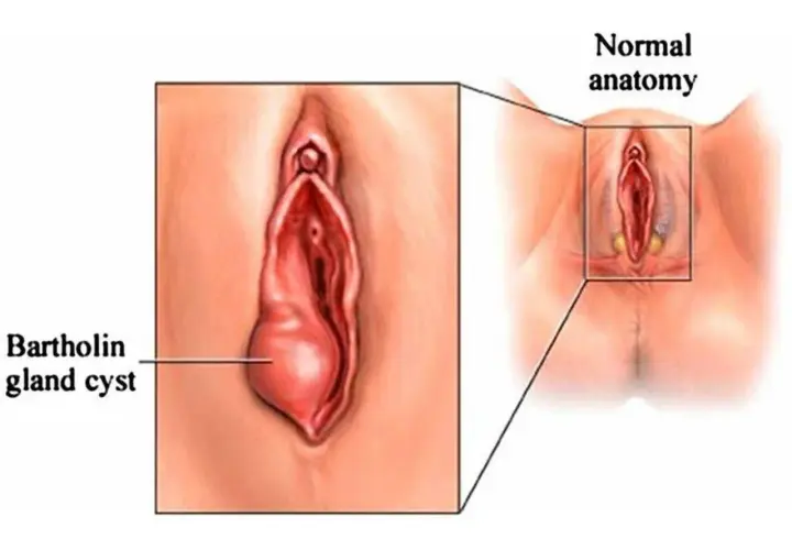 Powiększony gruczoł Bartholina po lewej, po prawej normalna anatomia.