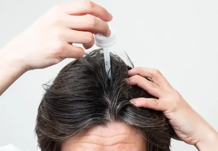 Persona aplica un gotero en su cuero cabelludo, buscando alternativas al minoxidil para el crecimiento capilar.