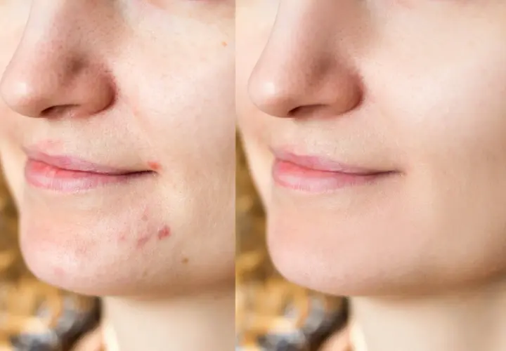 Avant/après : une peau avec des boutons et des pores dilatés devient lisse et nette. Découvrez comment faire disparaitre un bouton pour un teint parfait.
