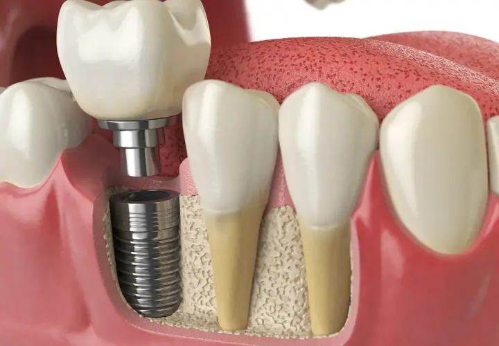 Impianto dentale che sostituisce un dente mancante, soluzione per l'edentulia.