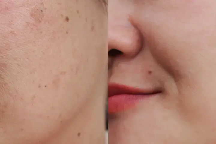 Comparación de piel: antes con manchas y poros visibles, después con piel lisa y uniforme.