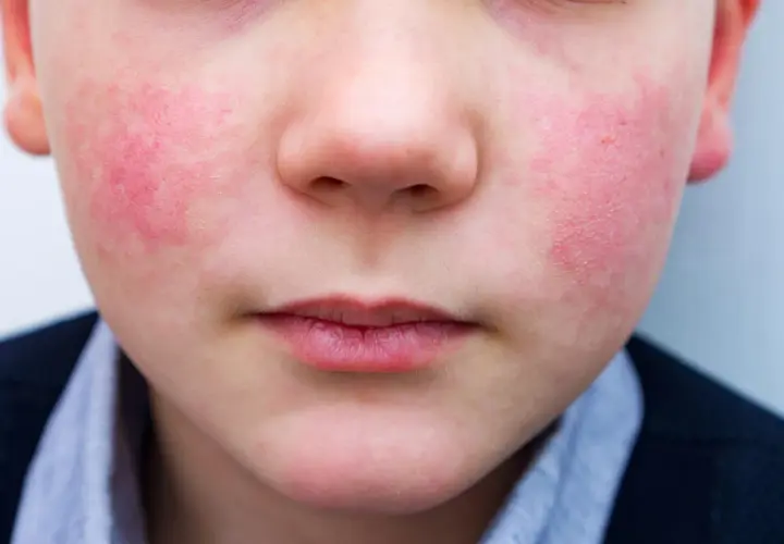 Primo piano del viso di un bambino con guance rosse e calde, forse per il freddo o un'allergia. La pelle appare leggermente screpolata.