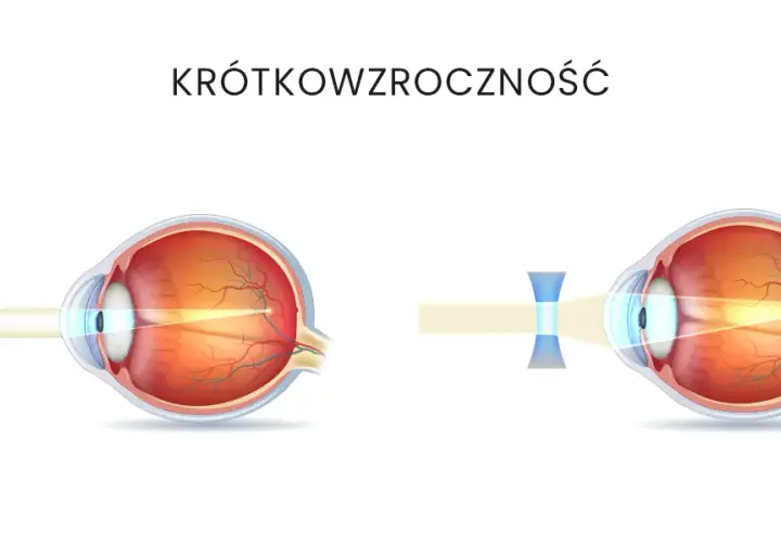 Jak wyleczyć krótkowzroczność i poprawić jakość widzenia?