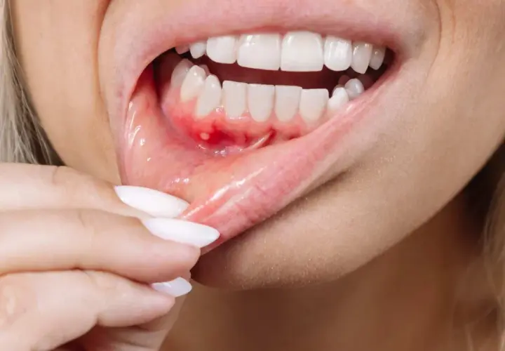 Detalle de una boca con úlceras y enrojecimiento, mostrando posibles causas de boca irritada por dentro.
