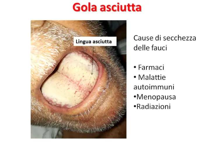 Lingua secca e pallida, sintomo di gola asciutta. Cause: farmaci, malattie autoimmuni, menopausa, radiazioni.