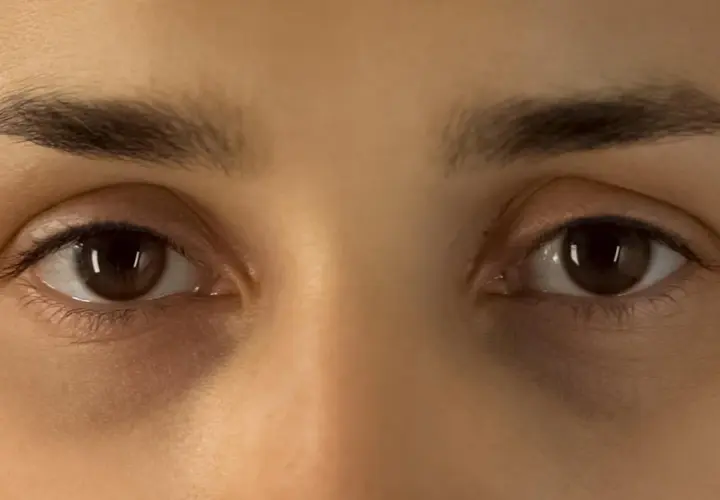 Augenringe mangel an Schlaf. Dunkle Schatten unter den Augen deuten auf Müdigkeit hin.