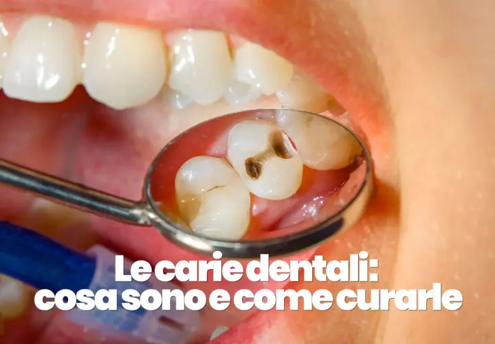 Denti con evidenti carie visibili nello specchietto del dentista.