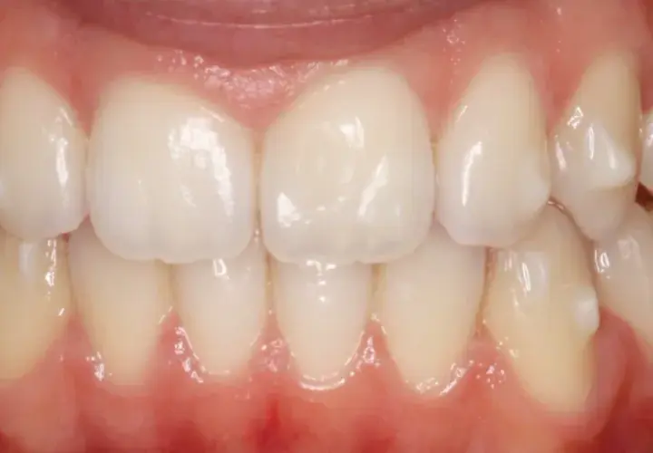 Dientes alineados y sanos, resultado de un tratamiento de ortodoncia invisible, **invisalign sin ataches**.