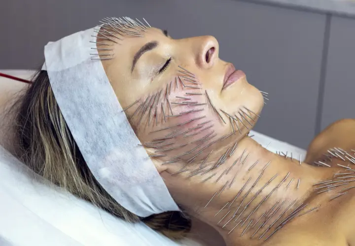Kobieta poddana zabiegowi akupunktury twarzy i szyi. Liczne igły wbijane są w skórę, co jest częścią terapii needle shaping.