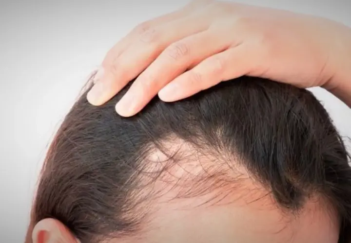 Mano tocando el cuero cabelludo con zonas de cabello escaso. ¿Qué vitamina me falta si se me cae el pelo?