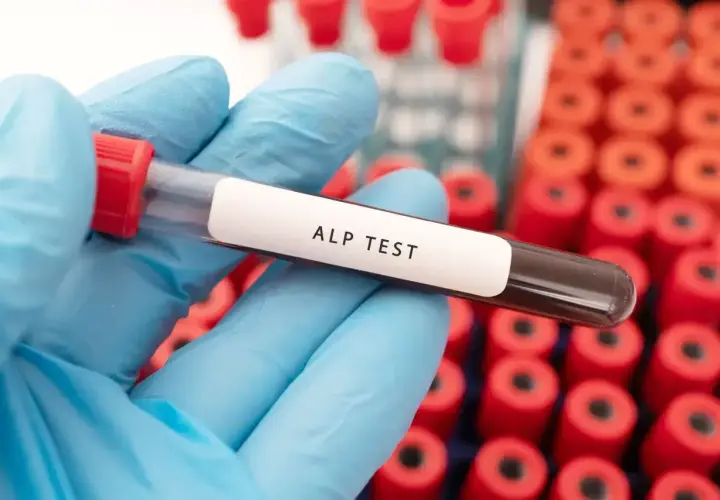 Rękawiczka w niebieskiej rękawiczce trzyma probówkę z napisem "ALP TEST". To badanie poziomu fosfatazy alkalicznej.