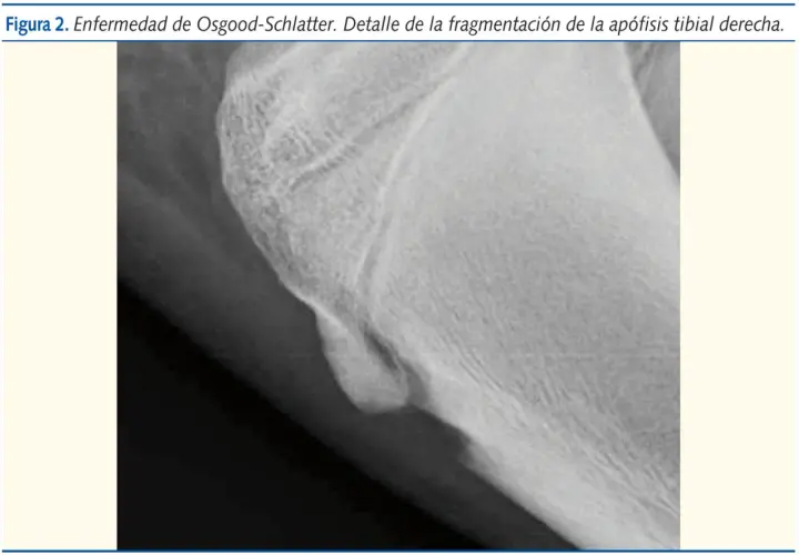Radiografía de rodilla que muestra fragmentación de la apófisis tibial derecha, indicativo de Osgood-Schlatter.