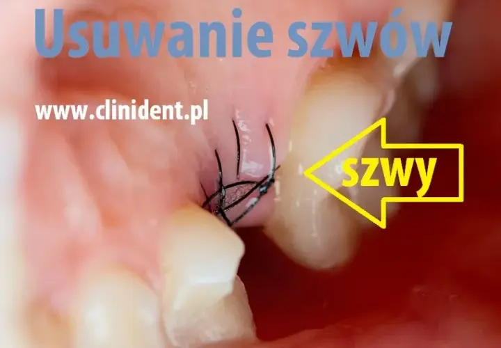 Ile kosztuje zdjęcie szwów u dentysty? Ceny, które zaskoczą!