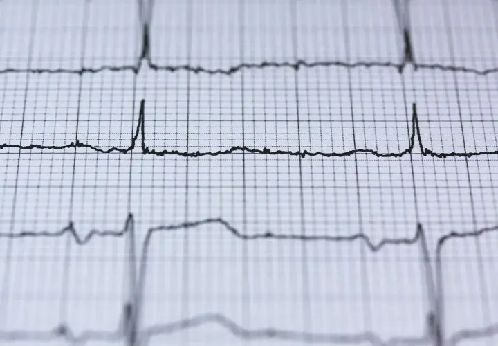 EKG z migotaniem przedsionków. Czy to powód do obaw przed wyrwaniem zęba? Analiza rytmu serca.