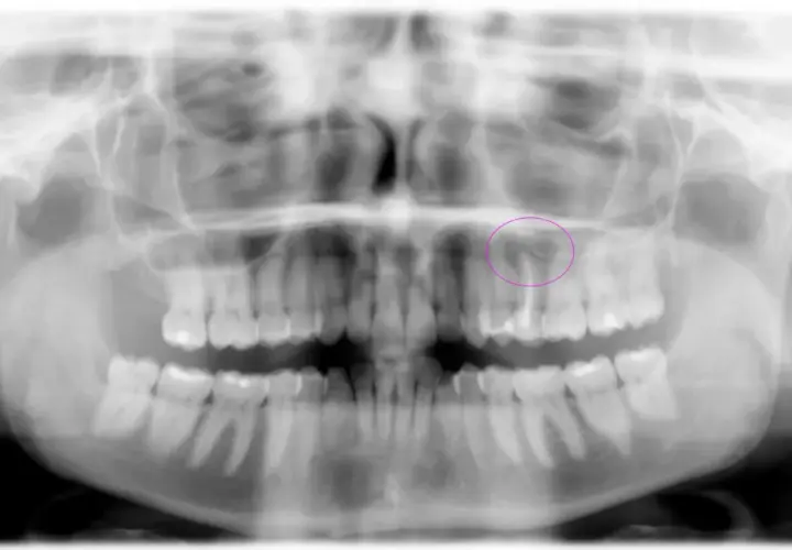 Radiografía panorámica dental que muestra la necesidad de una exodoncia quirúrgica de un diente superior, resaltado en círculo.