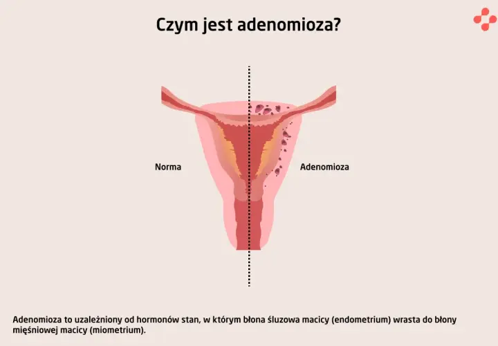 Ilustracja porównuje zdrową macicę z macicą z **adenomiozą**, gdzie tkanka endometrium wrasta w mięsień macicy.