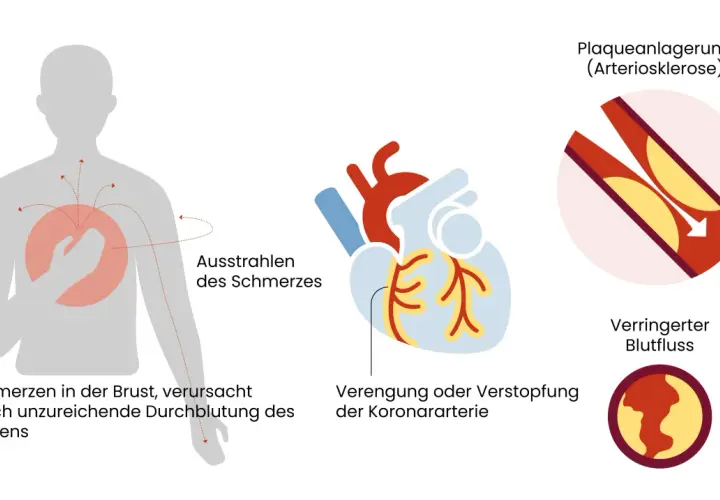 Brustschmerzen, die in Arme ausstrahlen, sind ein Symptom von Angina Pectoris, verursacht durch verengte Koronararterien und verringerten Blutfluss zum Herzen.