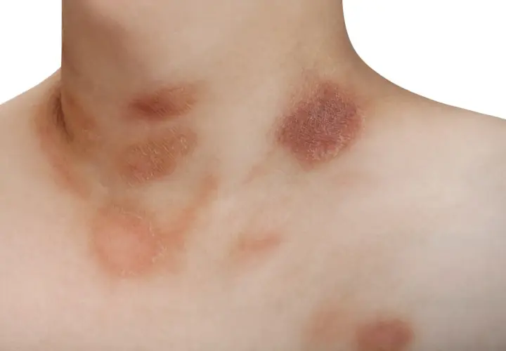 Macchie cutanee sul collo e petto, possibili manifestazioni di pitiriasi rosea di Gibert, a volte associate a stress.