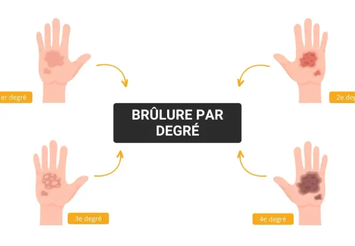 Illustration montrant l'évolution des brûlures de 1er degré à 4e degré sur une main. Le traitement d'une brûlure premier degré est le plus simple.