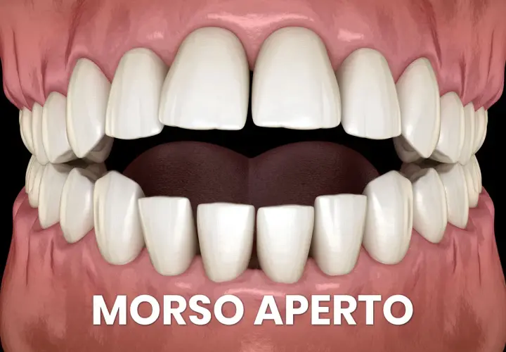 Denti bianchi e gengive rosa, con la scritta "MORSO APERTO". La lingua morsicata è visibile tra gli incisivi inferiori.