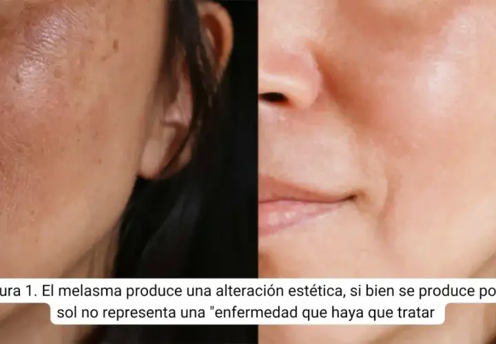 Comparación de piel con melasma y piel tratada. El ácido tranexámico para qué sirve: mejora manchas y unifica el tono.