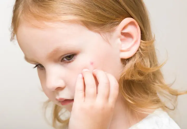 Un petit bouton rouge sur la joue d'une fillette aux cheveux blonds, peut-être un bouton de la 5ème maladie.