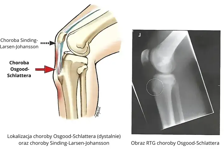 Ilustracja anatomiczna i RTG kolana pokazują lokalizację choroby Osgood-Schlattera.