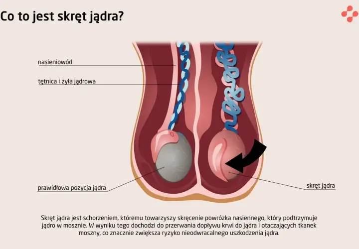 Ilustracja pokazuje prawidłową pozycję jądra i jego skręt. Skręt jądra to stan, gdy powrózek nasienny się skręca, blokując dopływ krwi.
