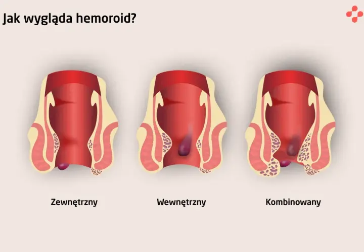 Ilustracja pokazuje zewnętrzne, wewnętrzne i kombinowane hemoroidy. Wczesne objawy raka odbytu mogą być mylone z hemoroidami.