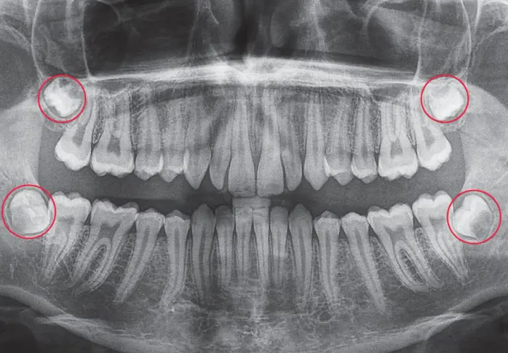 Radiografía panorámica dental. Se observan cuatro muelas del juicio impactadas, con posible hematoma tras extracción.