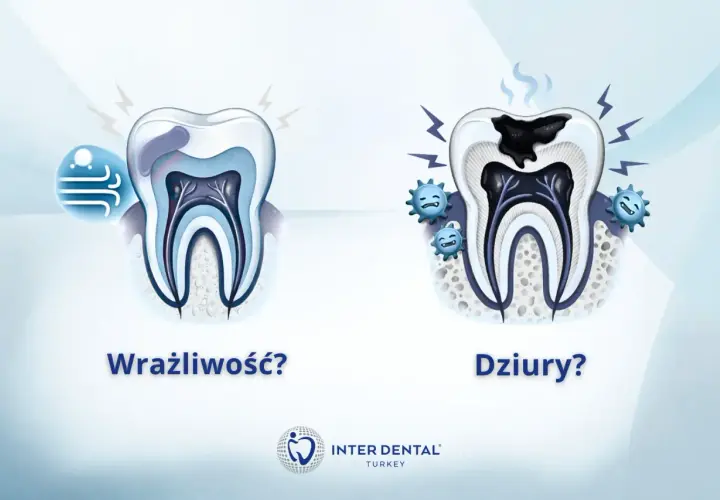 Wrażliwy ząb reaguje na zimno, a próchnica powoduje ból zęba przy nagryzaniu.