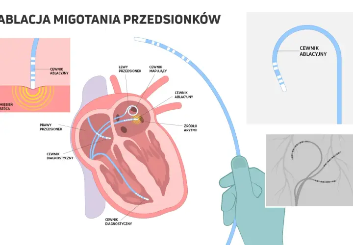 Ablacja migotania przedsionków: cewniki diagnostyczne i ablacyjne docierają do serca, by zlokalizować i zniszczyć źródło arytmii.