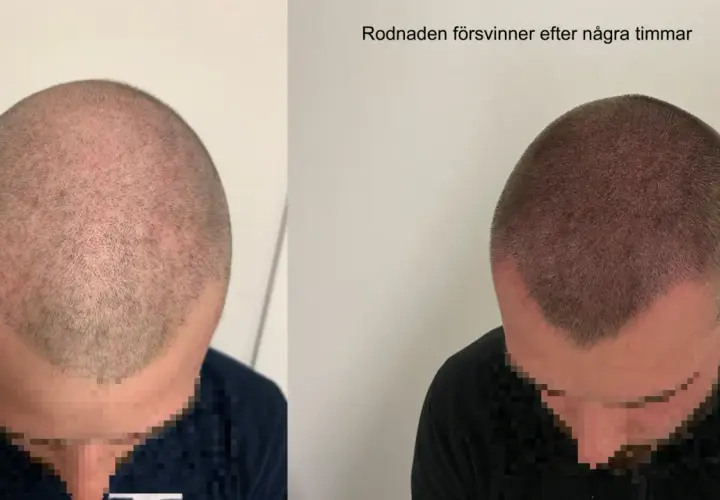Före och efter bild på en hårtransplantation. Rodnaden i hårbotten, som kan uppstå efter att man vill exfoliera hårbotten, försvinner efter några timmar.