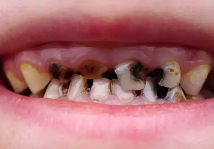 Jak wyleczyć próchnicę bez dentysty? Kiedy to możliwe?