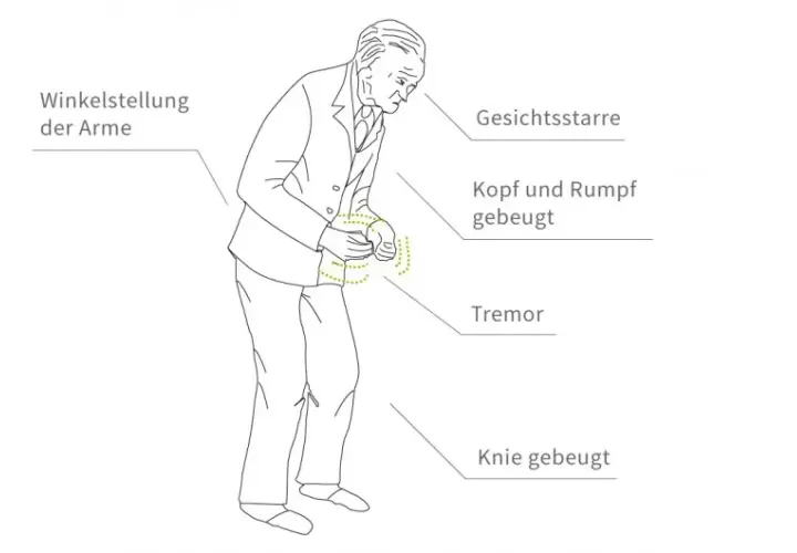 Diagnostik Parkinson Krankheit: So erkennen Sie die Symptome rechtzeitig