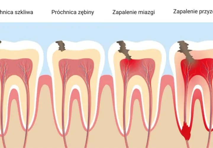 Ból zęba: czy to zapalenie miazgi? Rozpoznaj kluczowe objawy!