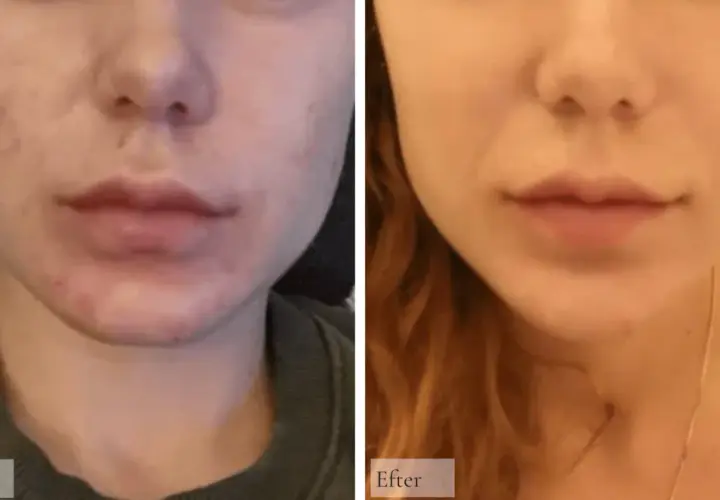 Före och efter bilder visar en hud med hyperpigmentering behandling. Huden är klarare och jämnare efter behandlingen.