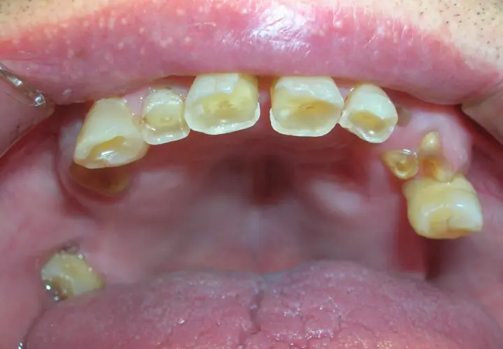 Boca con dientes desgastados y caries. Si los de abajo se mueven, los de arriba se caen.