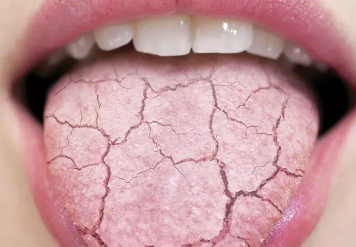 Lengua agrietada y seca, indicando posible boca ardorosa. Busca un tratamiento natural para aliviar la sequedad.