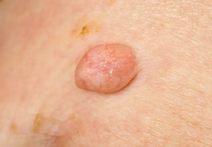 Zmiana skórna, która może być jednym z objawów HPV. Widoczny różowy, brodawkowaty narośl na skórze.