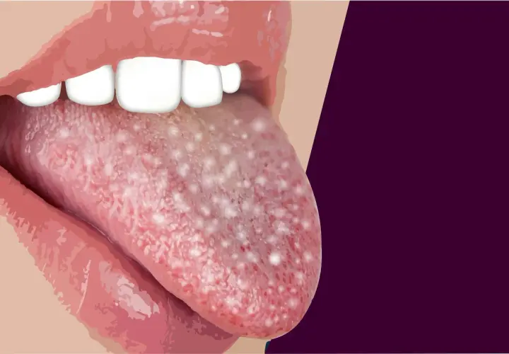 Lingua con puntini bianchi visibili, che potrebbero indicare una condizione medica.