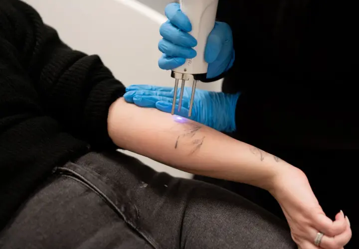 En person får en tatuering borttagen med laser. Undrar du över ta bort tatuering pris?