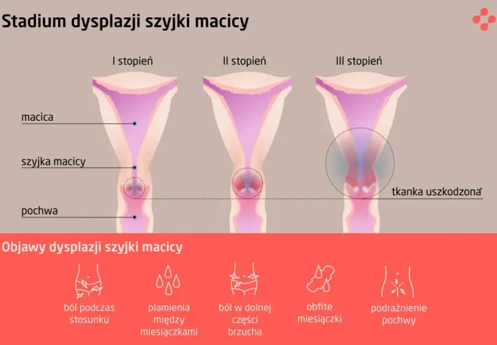 Grafika pokazuje stadia dysplazji szyjki macicy: I, II i III stopień, z zaznaczonymi objawami jak ból, plamienia i podrażnienie.