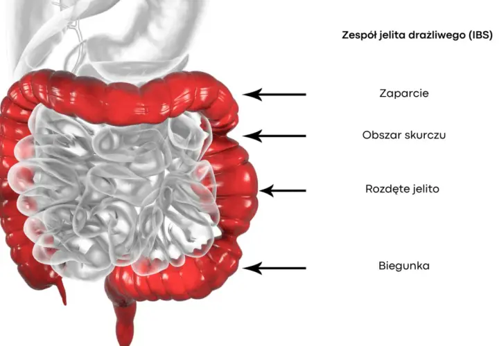Zespół jelita drażliwego objawy – co powinieneś wiedzieć z forum