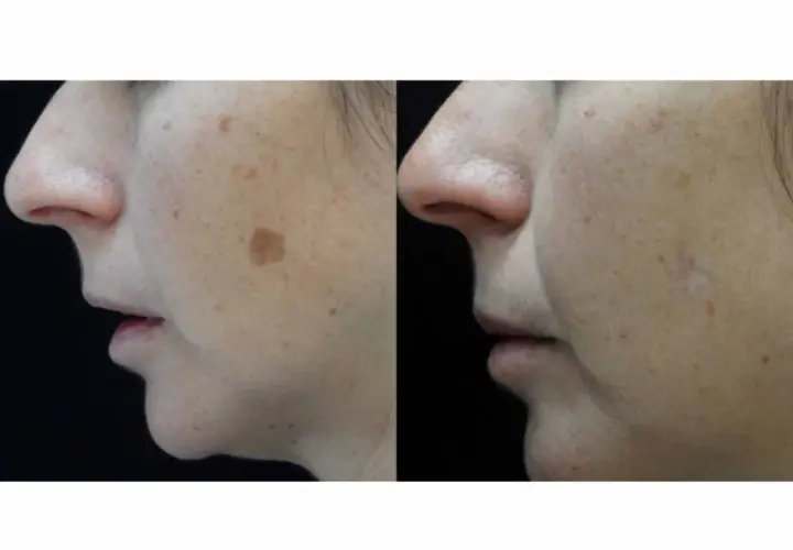 Comparación de piel con manchas solares antes y después de un tratamiento.
