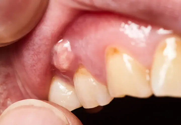 Un agujero en la encía con pus, cerca de los dientes, indica una posible infección.